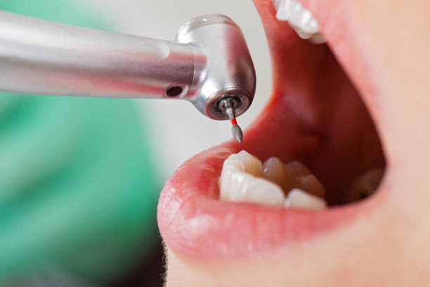 Best Emergency Dental Care for Broken or Chipped Teeth in Hartford, SD